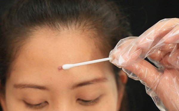 Thuốc trị mụn-Cách trị mụn nhanh nhất