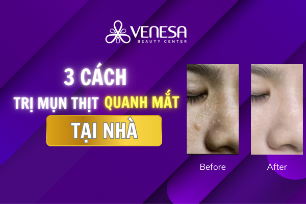 3 cách trị mụn thịt quanh mắt tại nhà đơn giản mà ít tốn kém