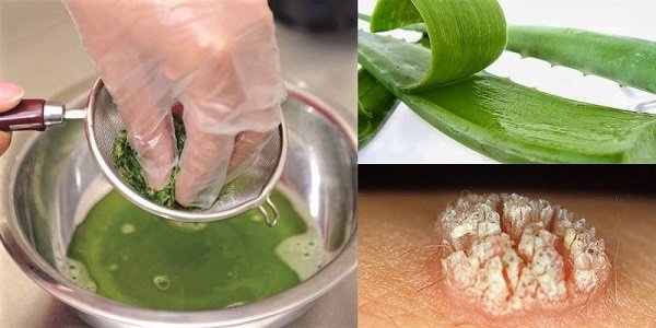 Trị mụn cóc bằng lá tía tô và nha đam