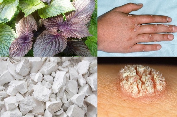 Trị mụn cóc bằng lá tía tô và kem đánh răng