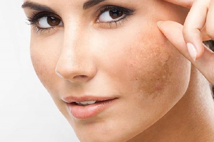 Trị nám hiệu quả với bộ mỹ phẩm trị nắm của Bijindo