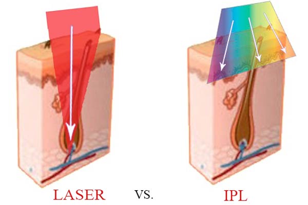 ưu nhược điểm của công nghệ IPL