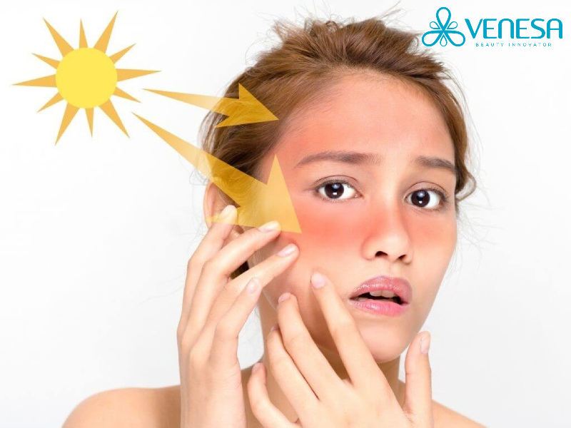 Tiếp xúc trực tiếp với ánh nắng mặt trời là một trong những nguyên nhân gây nám da