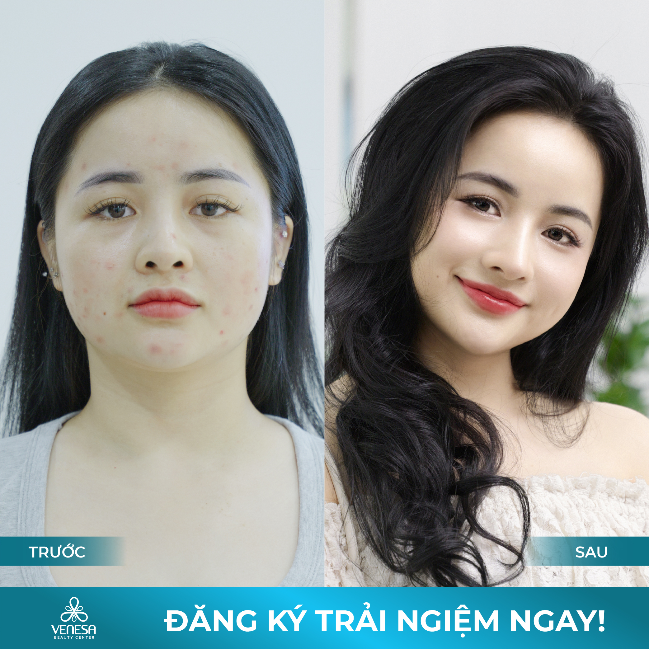 Điều Trị Mụn